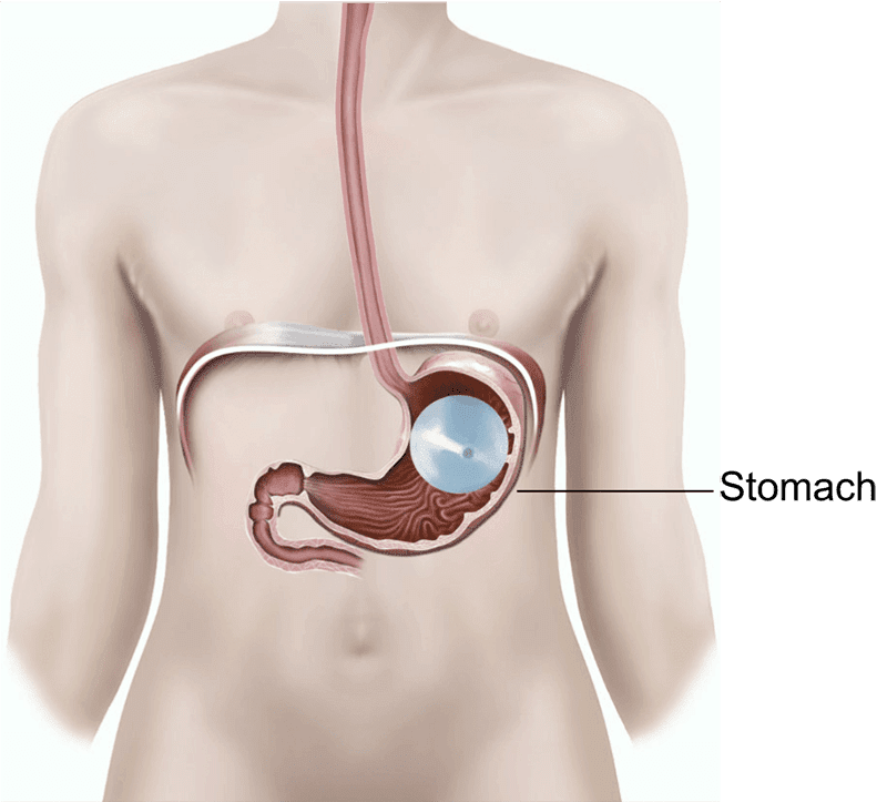 thegastricballoonarevolutionaryapproachtoweightloss