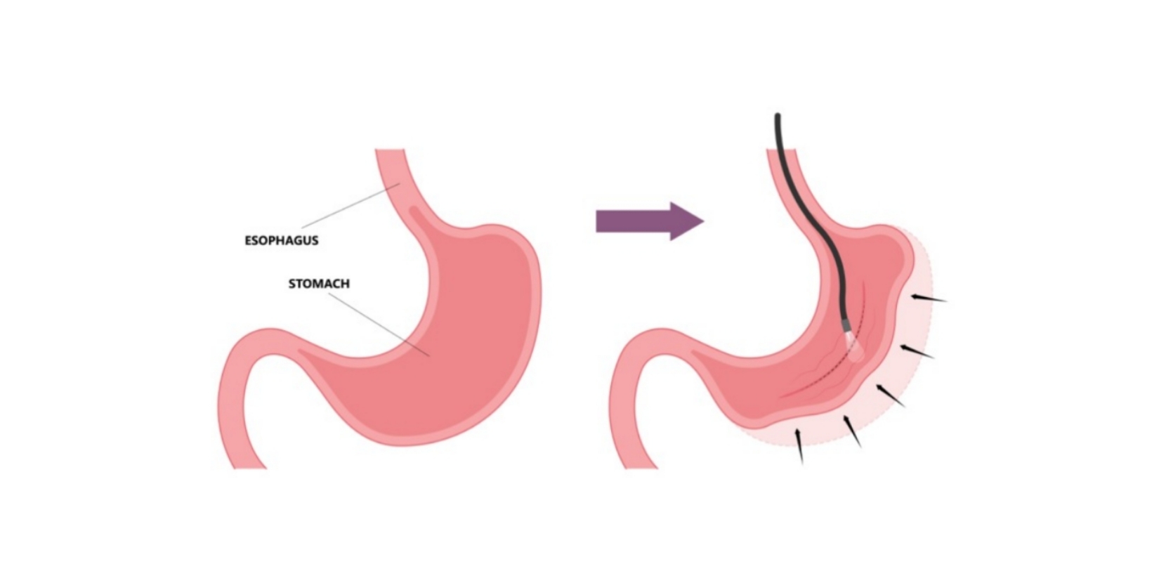 FAQ Endoscopic Sleeve Gastroplasty (ESG) Obesity Care Clinic