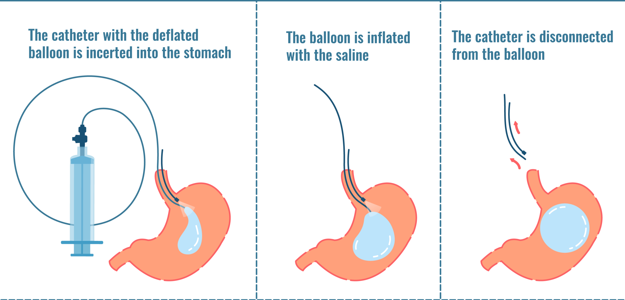 Gastric balloons redefining obesity treatment