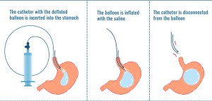 Gastric balloons :redefining obesity treatment
