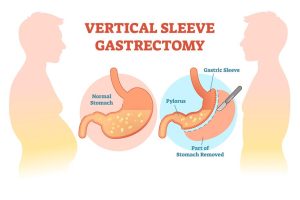 Long-Term Effects of Sleeve Gastrectomy on Weight Loss and Health Outcomes