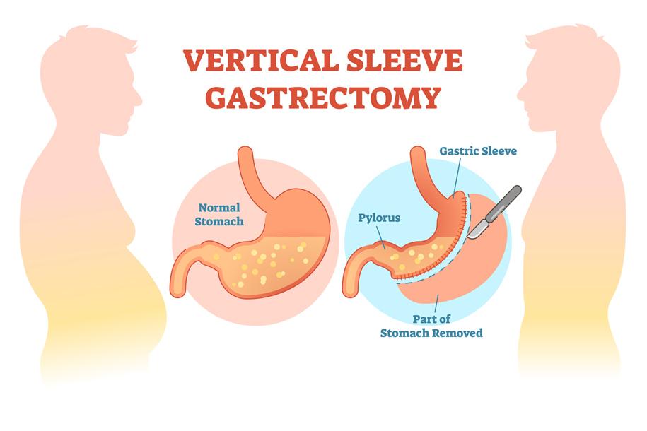 Long-Term Effects of Sleeve Gastrectomy on Weight Loss and Health Outcomes