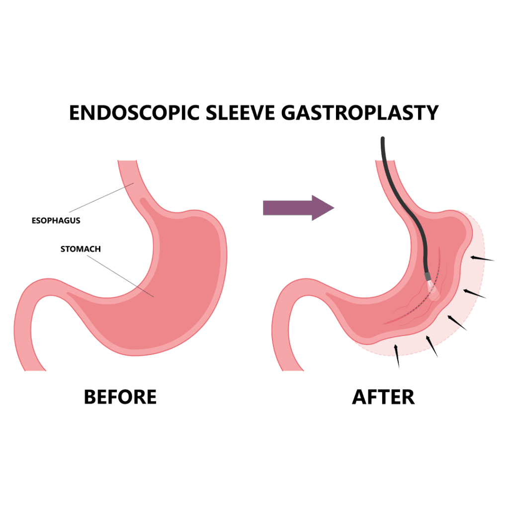 What to Expect During Gastric Bypass Surgery Recovery Obesity Care Clinic