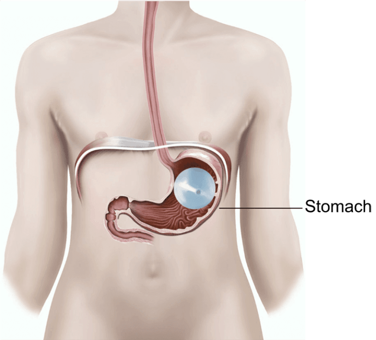 Understanding Gastric Balloons: A Comprehensive Guide to Non-Surgical Weight Loss