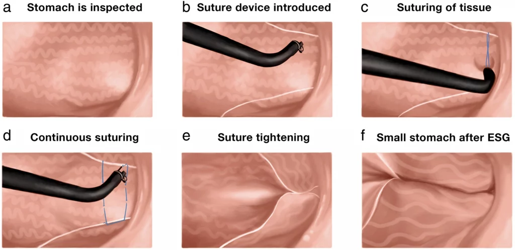 A Patient's Guide to Endoscopic Sleeve Gastroplasty