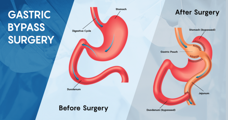 The Long-Term Effects and Risks of Gastric Bypass Surgery: Unveiling the Journey to Sustained Weight Loss