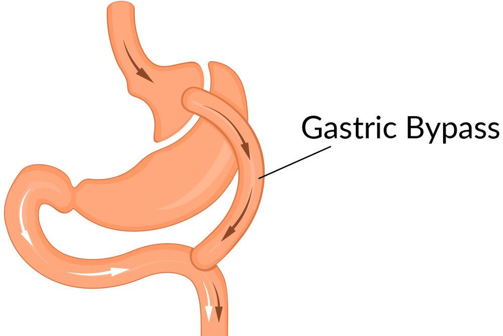 The Long Term Effects And Risks Of Gastric Bypass Surgery
