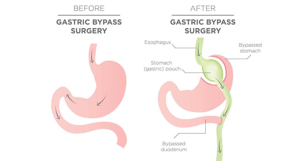 How to Determine if Gastric Bypass Surgery is Right for You