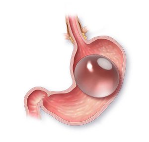 The Gastric Balloon: A Revolutionary Approach to Weight Loss