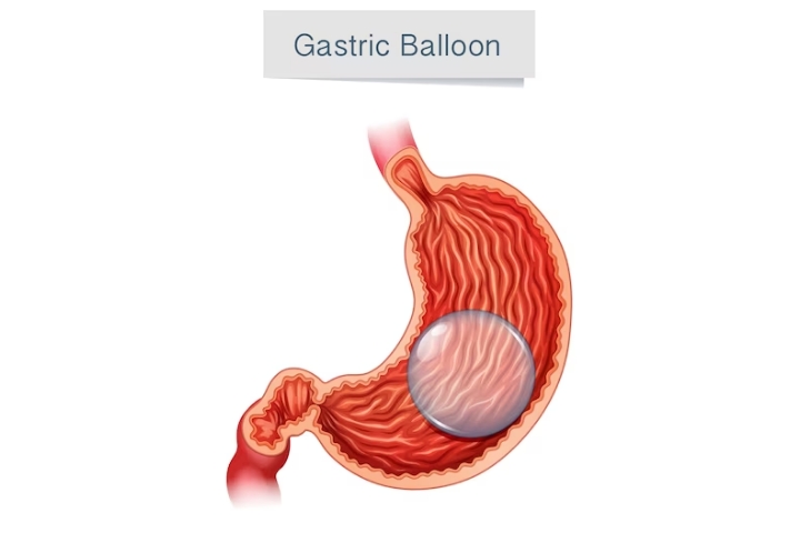 Navigating Non-Invasive Weight Loss: The Science Behind Gastric Balloons