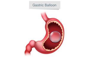 Harnessing the Potential of Gastric Balloons: A New Era in Bariatric Medicine​