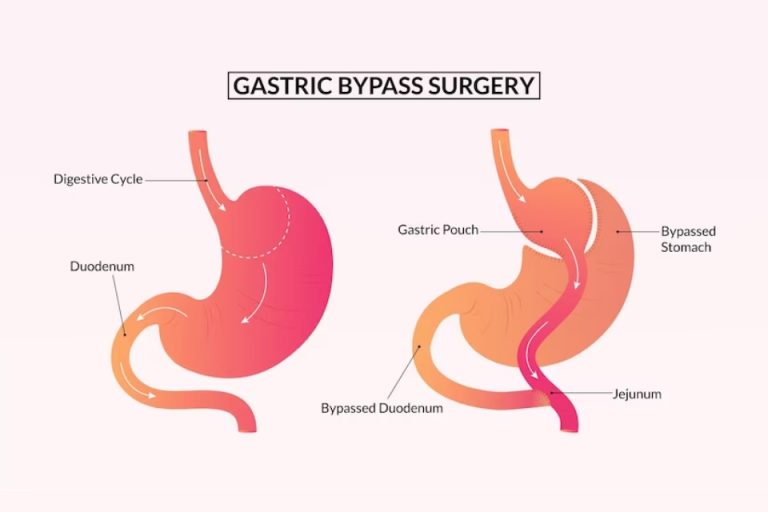 The Role of Nutrition and Exercise in Gastric Bypass Surgery Success