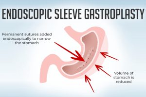 Long-Term Outcomes of Endoscopic Sleeve Gastroplasty