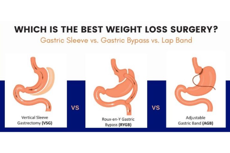 Gastric Bypass vs. Other Weight Loss Surgeries Which is Best