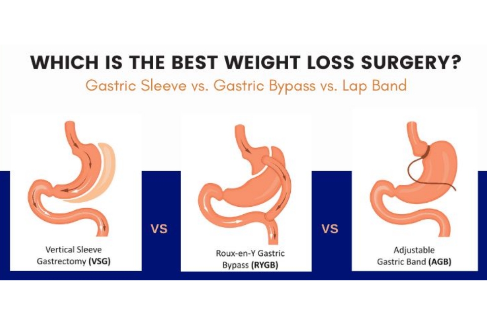 Gastric Bypass vs. Other Weight Loss Surgeries: Which is Best?