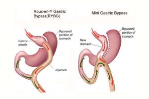 Understanding the Different Types of Gastric Bypass Procedures