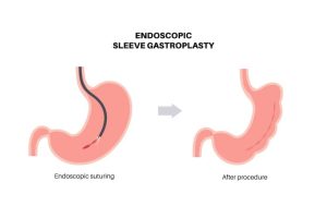 ESG vs. Traditional Bariatric Surgery: Pros and Cons