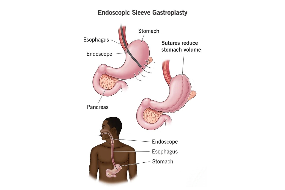 Understanding the Risks and Benefits of Endoscopic Sleeve Gastroplasty (ESG)