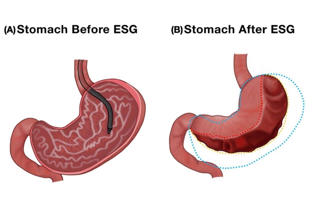 Endoscopic Sleeve Gastroplasty: The Future of Weight Loss Surgery?