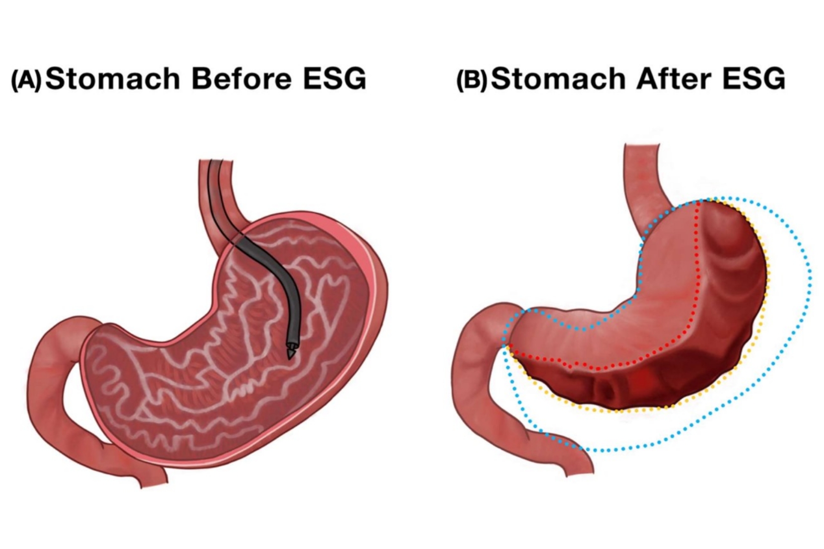 Frequently Asked Questions About Endoscopic Sleeve Gastroplasty