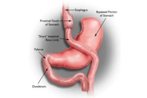 What to Expect During Gastric Bypass Surgery Recovery