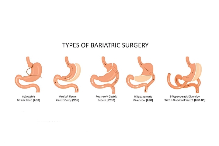 Bariatric Surgery for a Better Quality of Life: Is It for You?