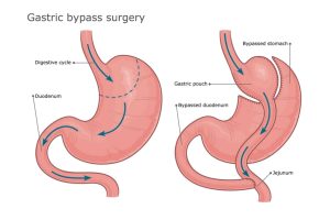 Battling Obesity: Gastric Bypass as a Game Changer