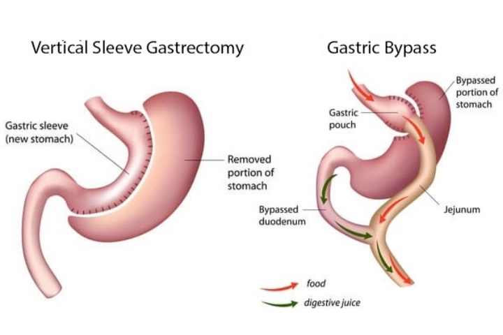 Gastric Bypass vs. Gastric Sleeve: Unpacking the Differences