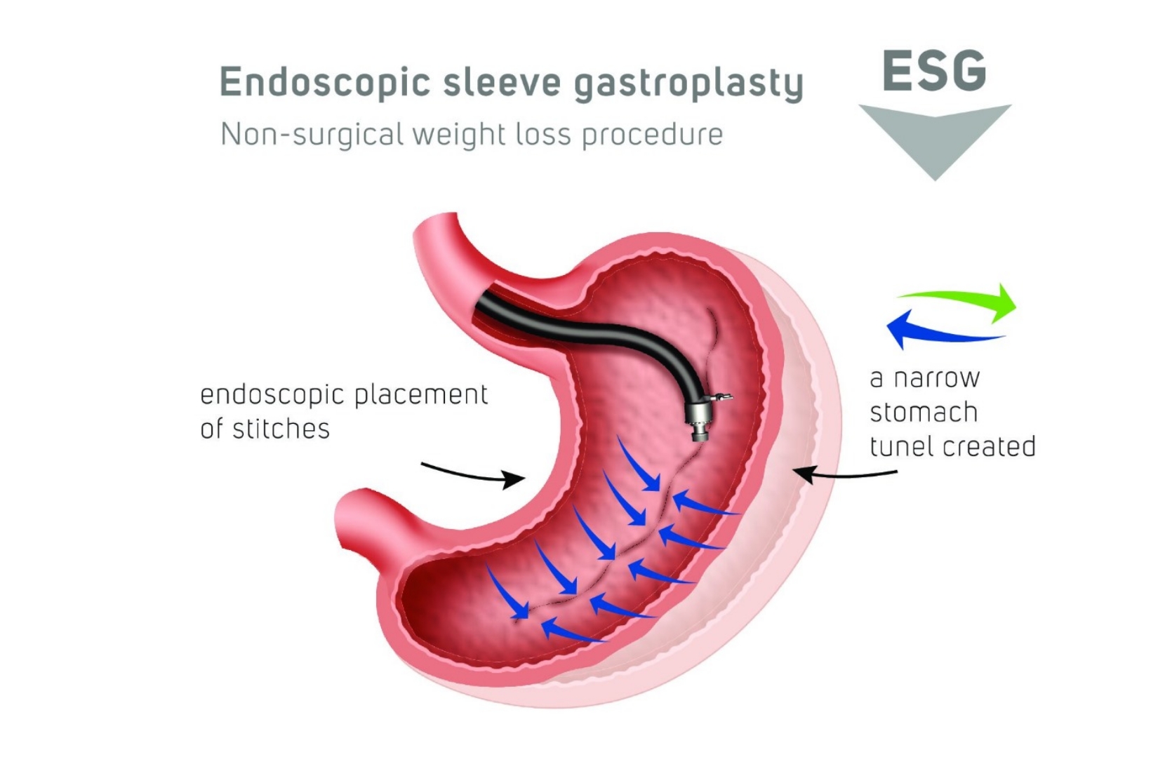 Endoscopic Options for Weight Loss