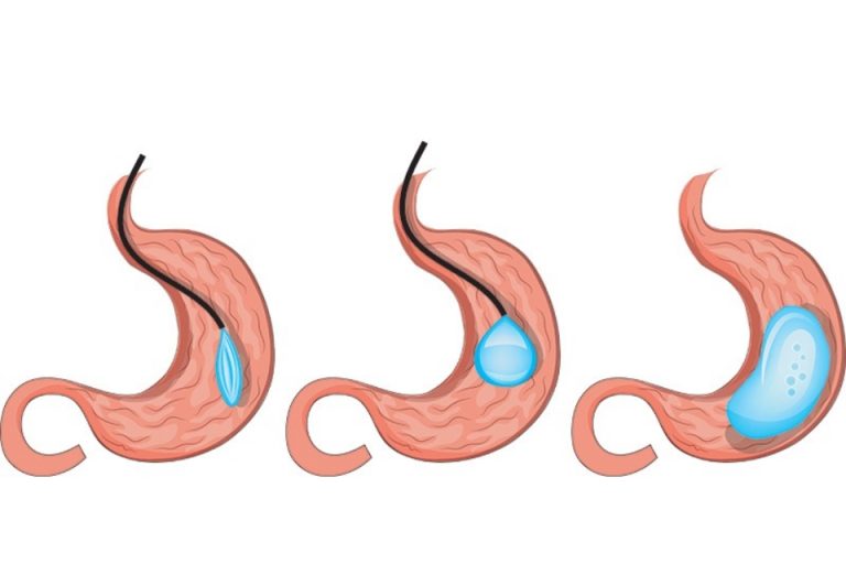 Gastric Balloon vs. Traditional Diets: Which Will You Choose?