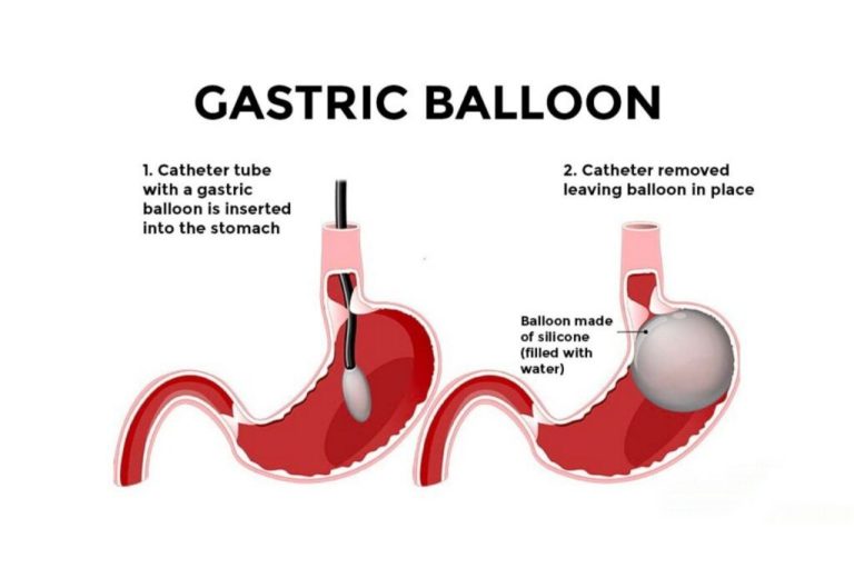 Empowering Change: Gastric Balloon and Your Mental Well-being