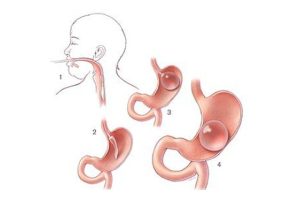 Gastric Balloons and Emotional Well-Being: A Winning Combination