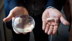 Intragastric Balloons Unveiled Key Points to Note Before You Dive In