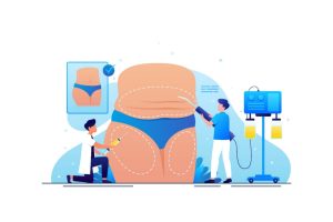 Liposuction vs. Bariatric Surgery: Which Option Against Obesity?