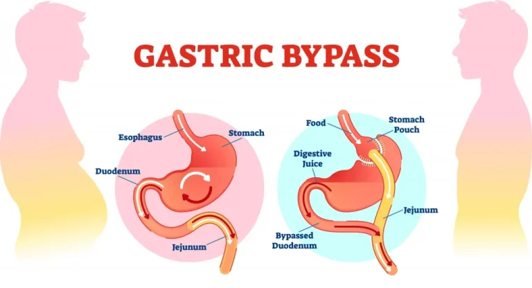 Understanding benefits gastric bypass: scientific explanation