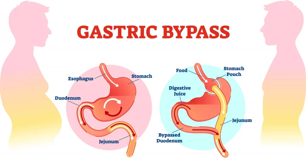 Understanding benefits gastric bypass: scientific explanation